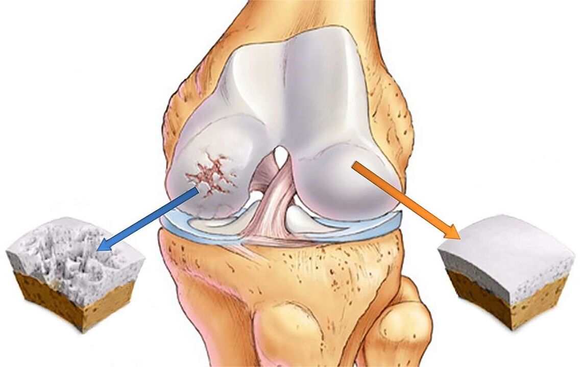 Destrukce chrupavky kolenního kloubu s gonartrózou