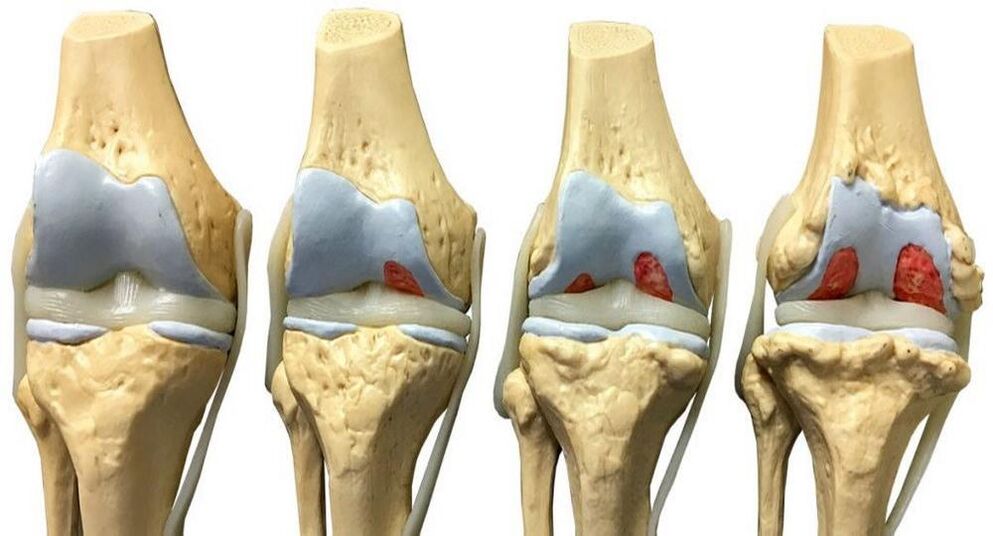 Etapy vývoje artrózy kolenního kloubu