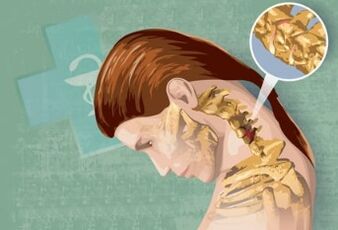 Reflexní příznaky cervikální osteochondózy
