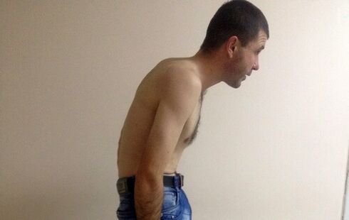 Ankylozující spondylitida může v průběhu let způsobit bolesti dolní části zad